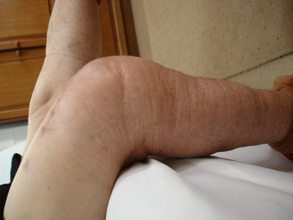 Artroplastia de genunchi