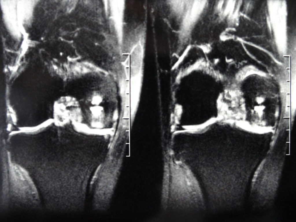 Artroscopia genunchiului