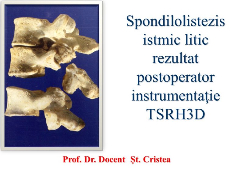 osteocondrita coloanei vertebrale osteoartrita articulațiilor fațete